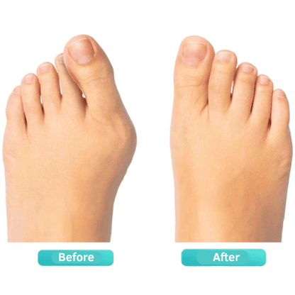 ORTHEO LAB®- BUNION FIX