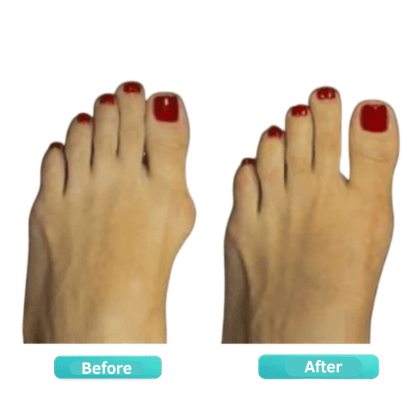 ORTHEO LAB®- BUNION FIX